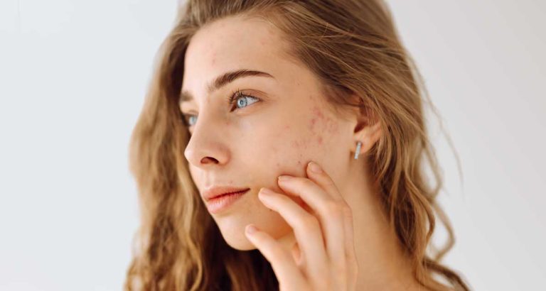 Acne@72x-50